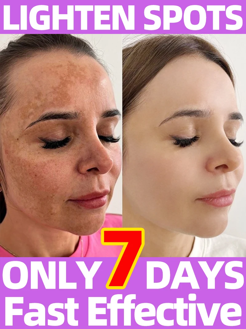 

Sun Age Dark Spot Freckles Chloasma Clear