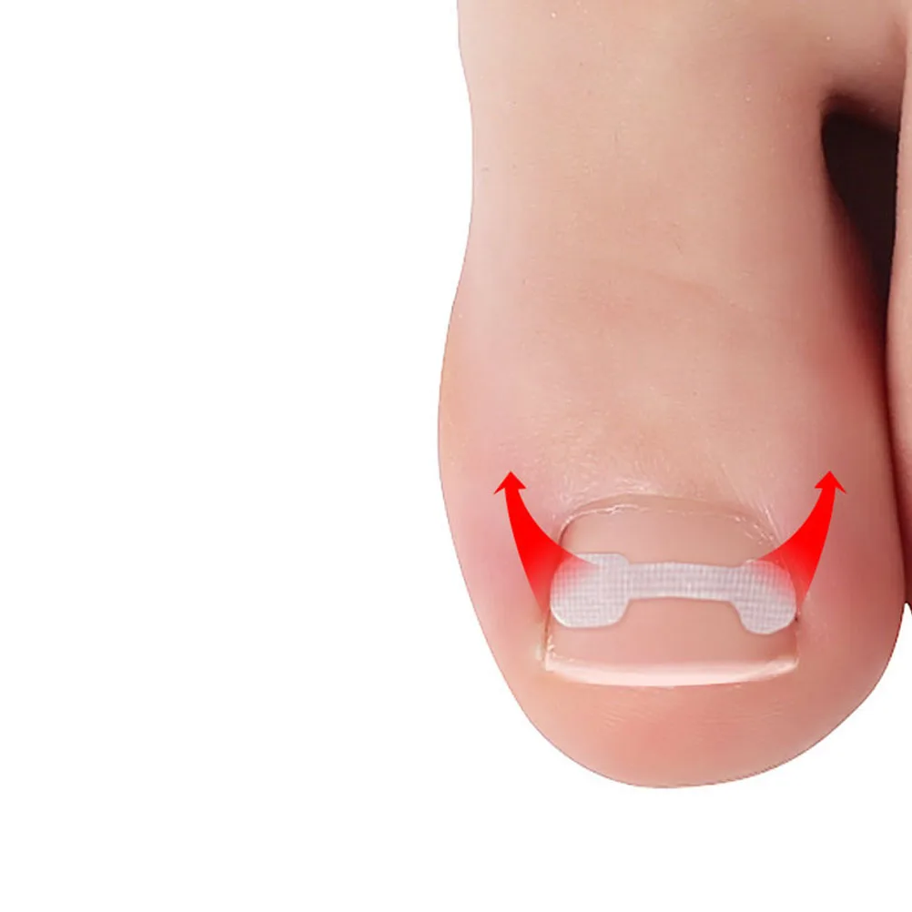 

30pcs Orthopedic Stickers Toenail Corrector White Resin Curved Patch Pain Relief Hallux Foot Care Tool For Men Women