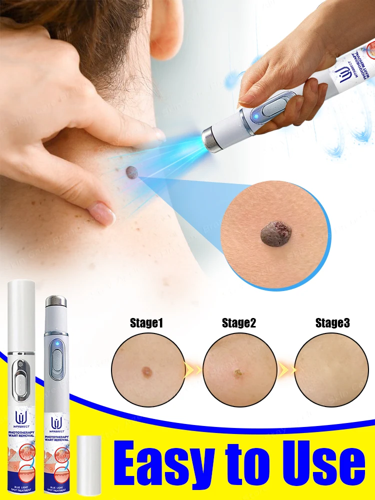 Sᴋɪɴ Cᴀʀᴇ Lᴀsᴇʀ Pᴇɴ Sᴋɪɴ Tᴀɢ  Mᴏʟᴇ Wᴀʀᴛ Rᴇᴍᴏᴠᴀʟ Tᴏᴏʟ Sᴋɪɴᴄᴀʀᴇ Gʀᴇᴇɴ Bᴇᴀᴜᴛʏ & Hᴇ