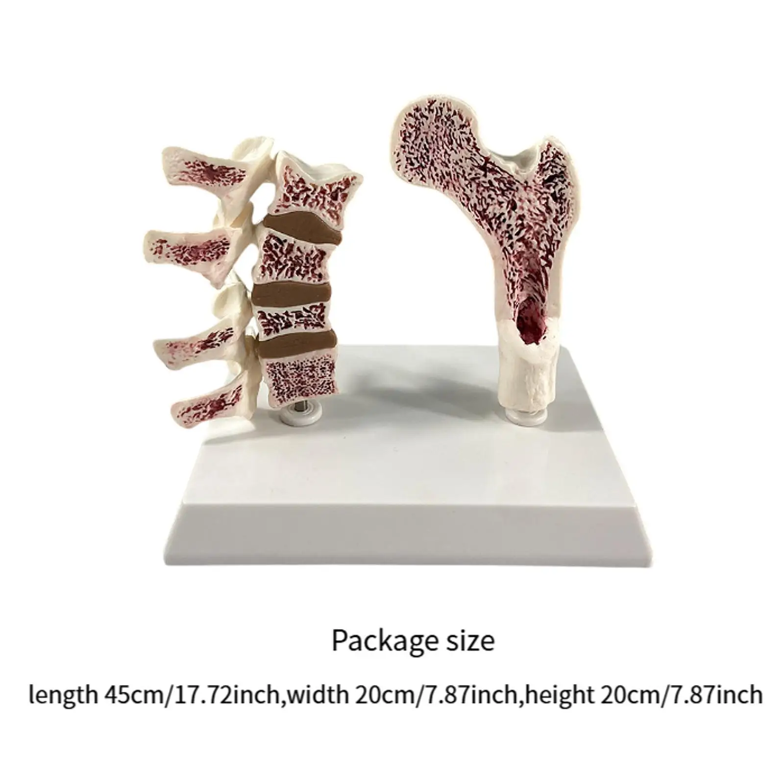 Human Femur Osteoporosis Anatomy Model, Include Leg Bone and Spine, Sturdy Versatile Learn Props Educational Tool for Home