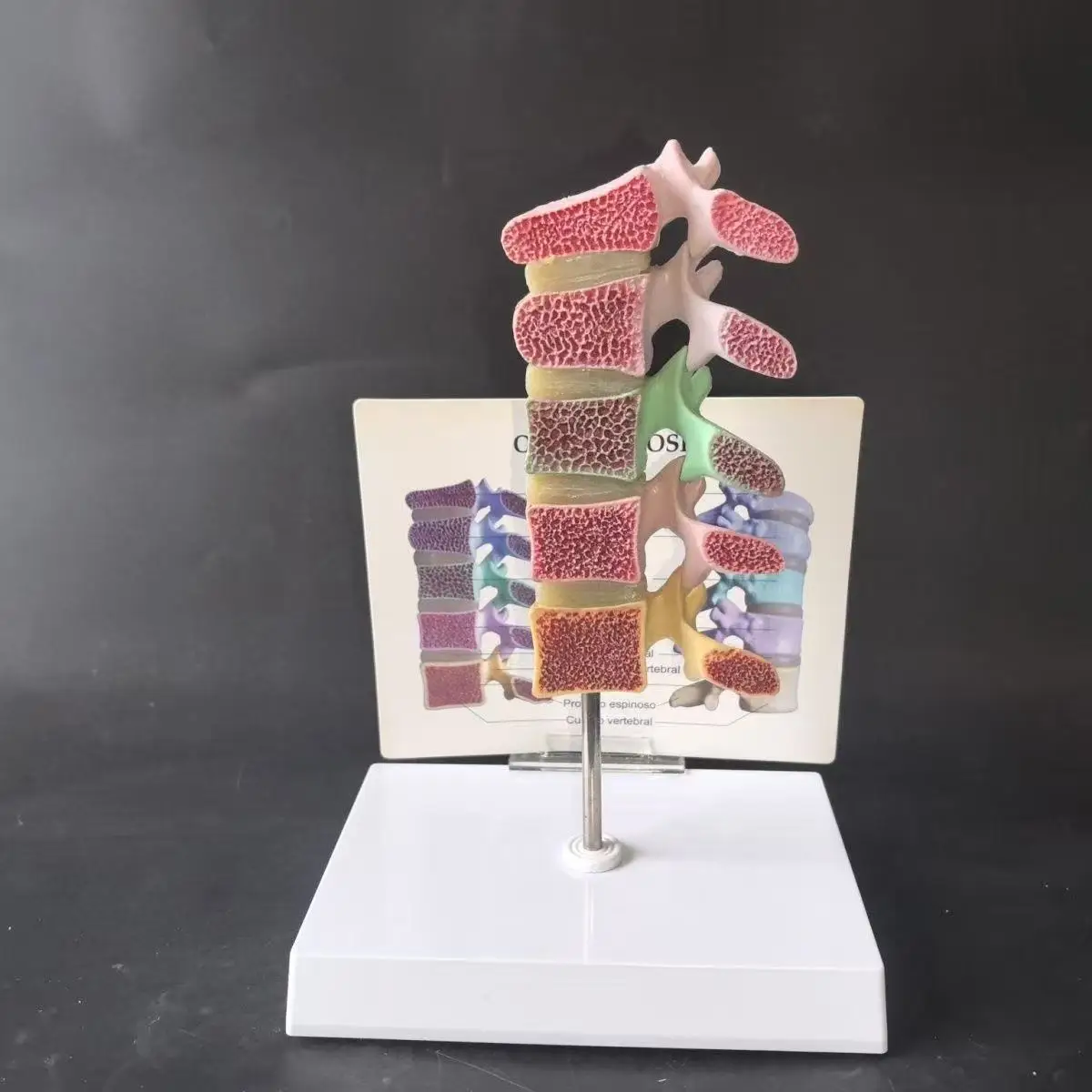 

Цветная модель 5-го поясничного позвонка человека с остеопорозом, модель поясничного позвонка в поперечном разрезе, модель позвоночника, модель скелета