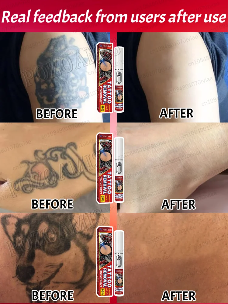 demaquillage-permanent-detatouage-indolore
