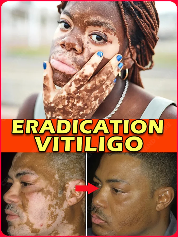 

Vitiligo ointment is effective in repairing the skin