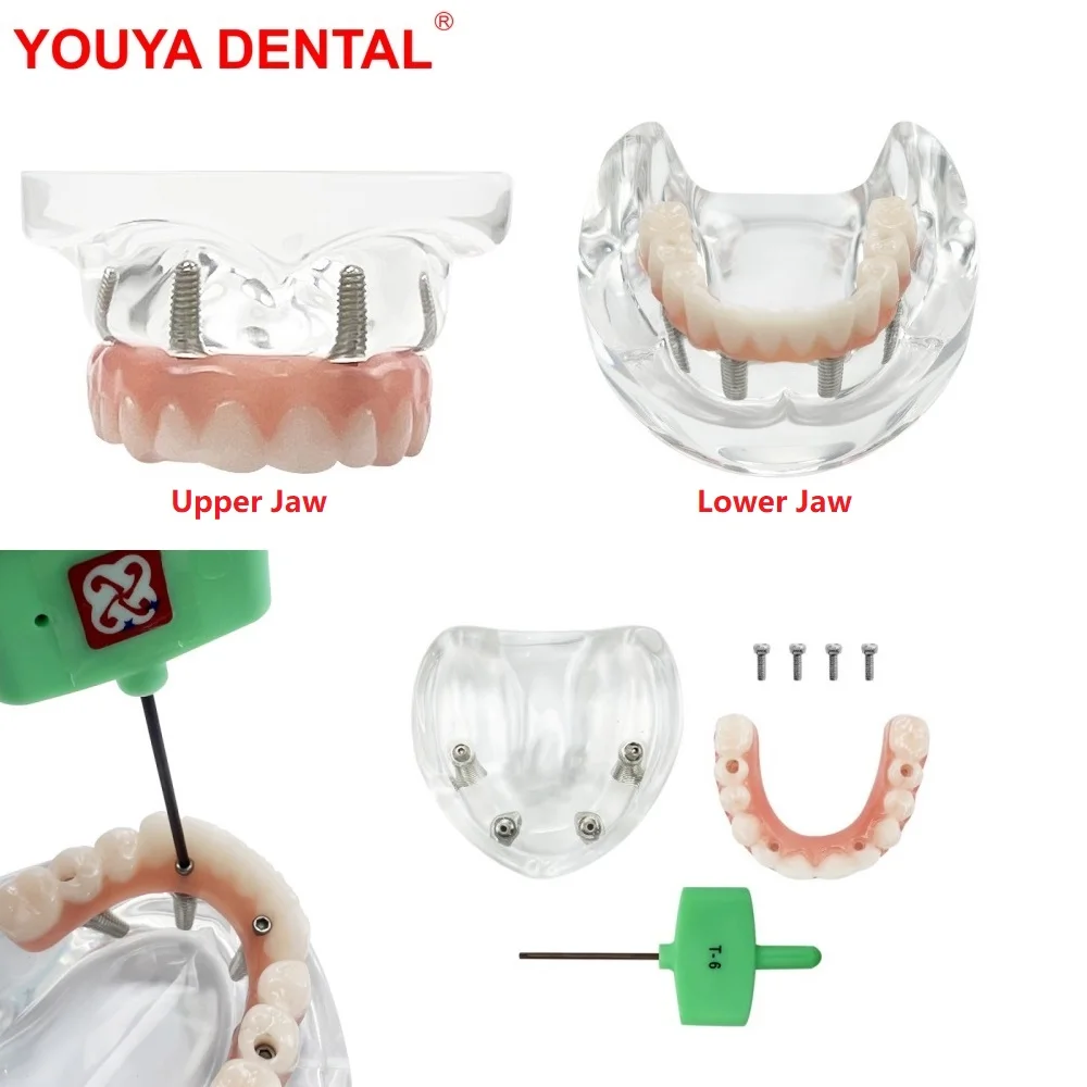 

Dental Overdenture Teeth Model With Removable Recondition Implants Upper/Lower Jaw All On 4 Implant Model For Education Teaching