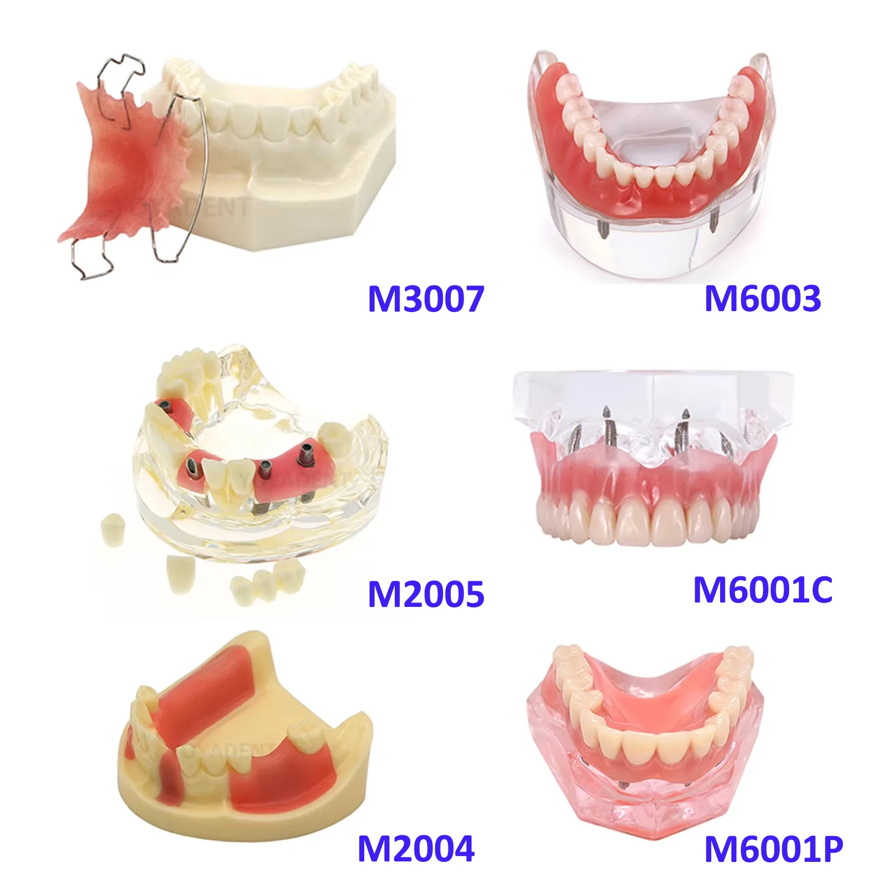 

Dental Teeth Implant Model Implant Overdenture 2/4 Implant Upper Lower Jaw Mandibular For Dentist Student Study Learning