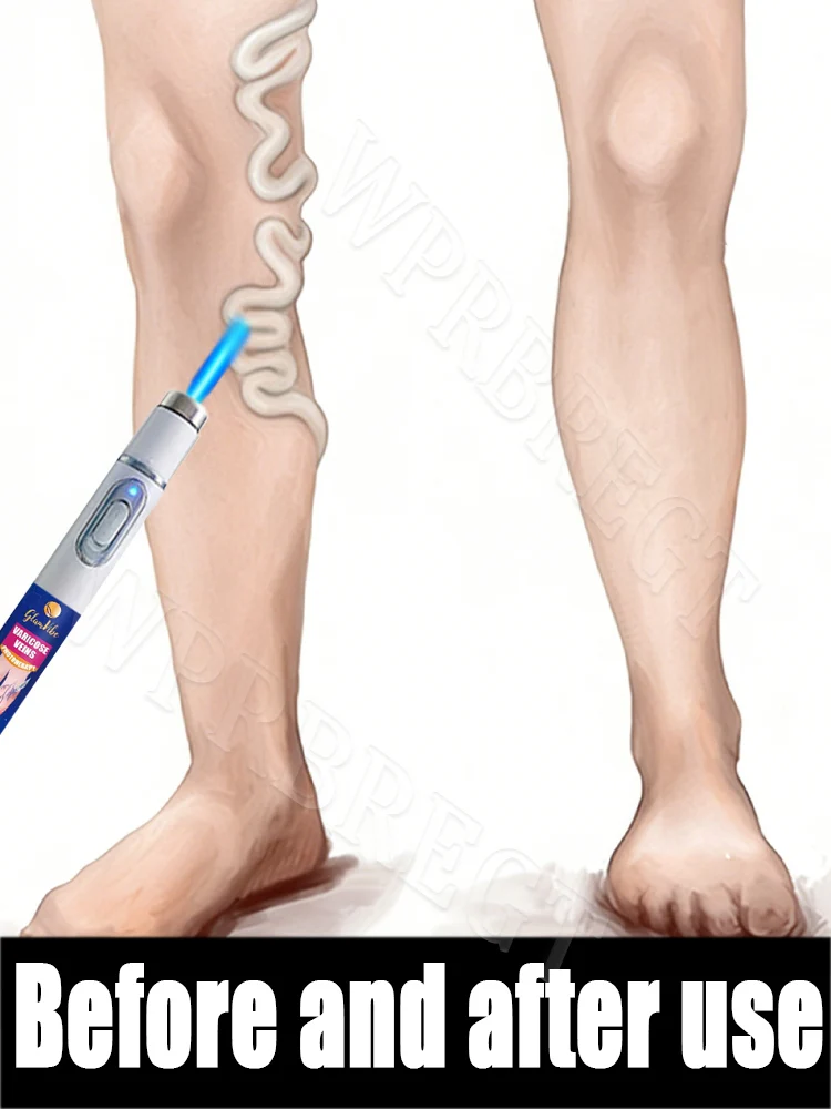 

No more worries about leg problems, unlock leg health in 7 days