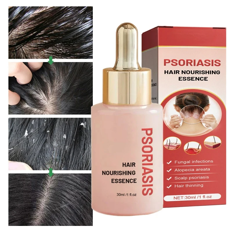 30ml Hair Treatment Remove Dandruff And Relieve Essence Prevent Loss Serum Oil Control Smooth Nourish Repair Hair Scalp Care