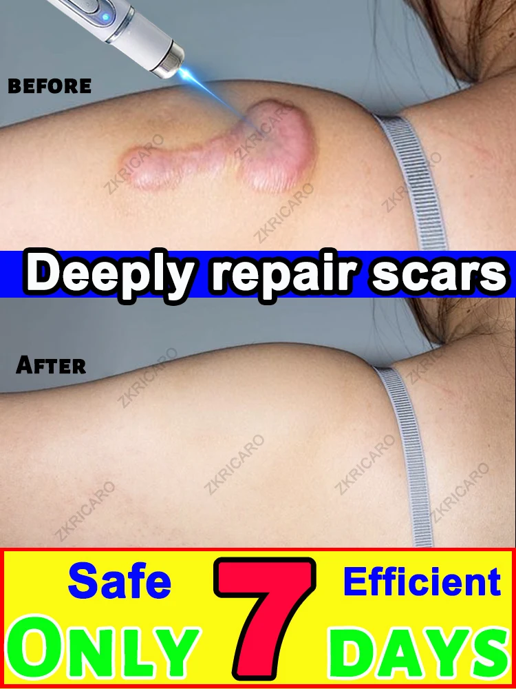 

New upgraded products can make scars go away