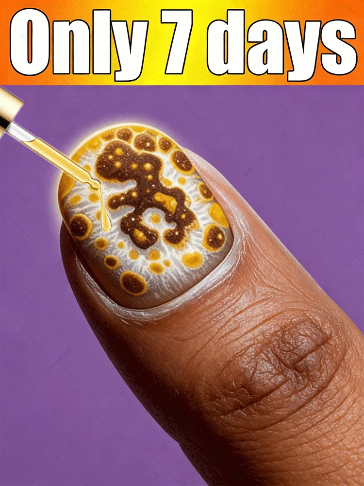 

2026 новых helps управлять внешним видом грибковых ногтей.