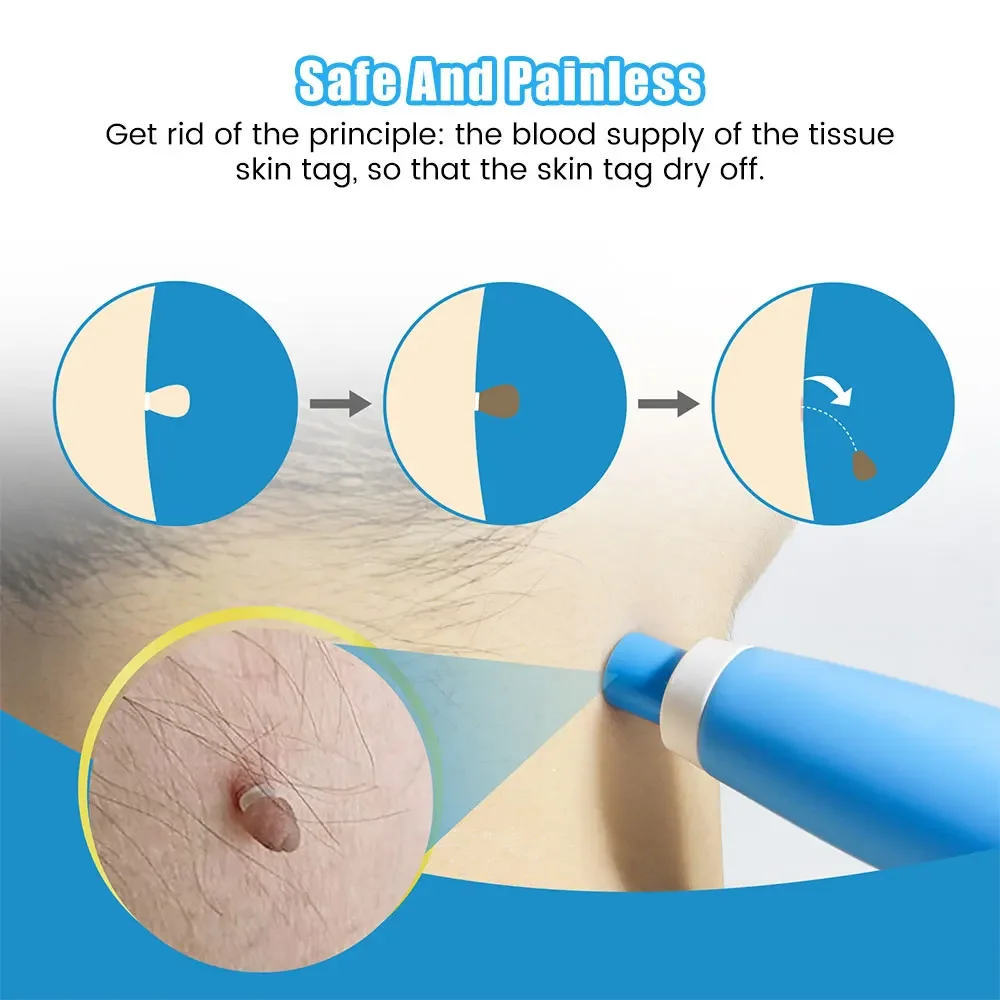 Auto Skin Tag Removal ชุดเครื่องมือไม่เจ็บปวดผิวป้าย Mole สิวกําจัดหูดปากกาทําความสะอาด Swabs Facial Skin Care เครื่องมือความงาม