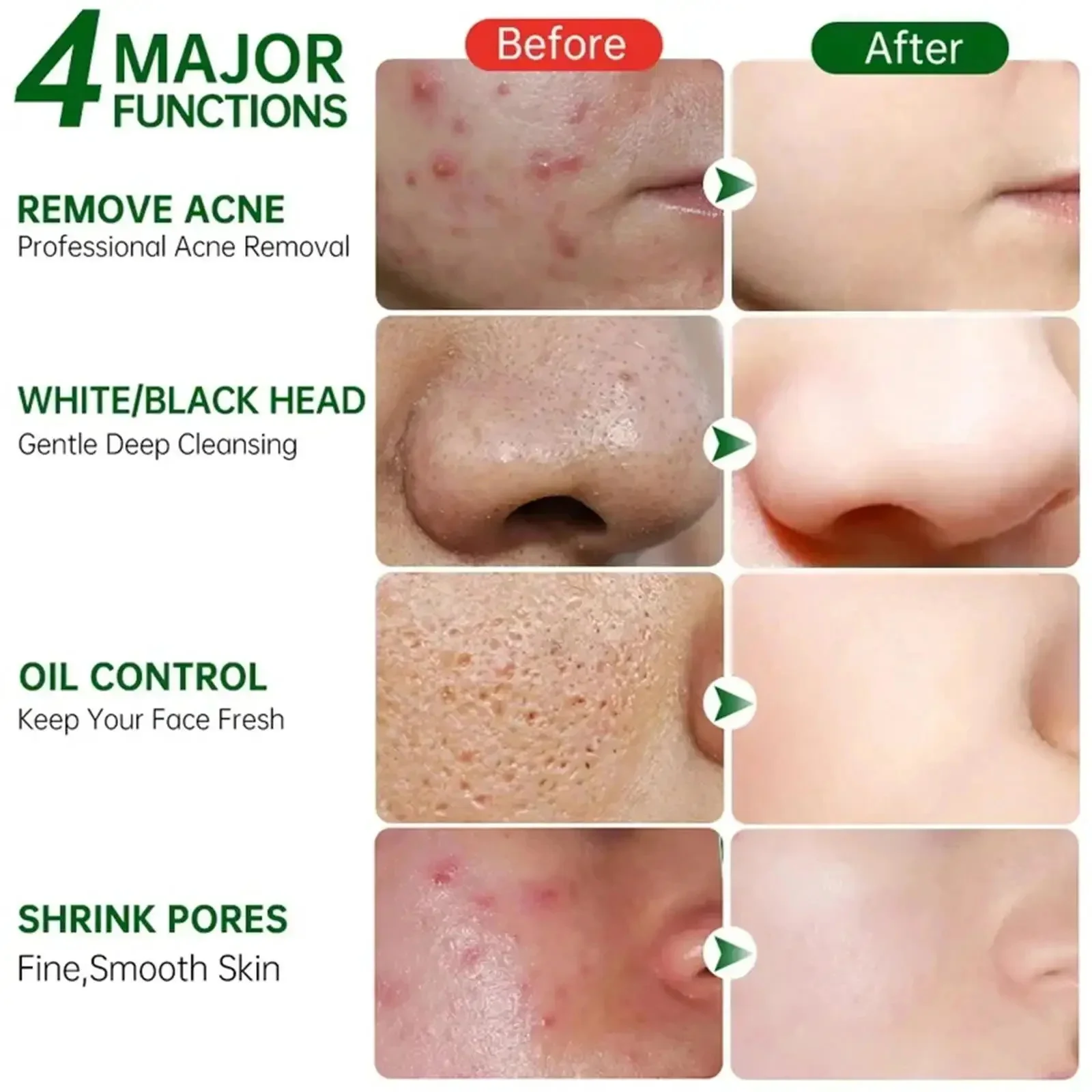 Porie Krimpende Crème Acne Pit Reparatie Product Voor Mannen Vrouwen Verwijderen Acne Print Litteken Grote Porie Anti-Inflammatoire Gladde Huidcrème