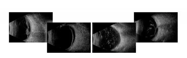 Ophthalmic ultrasound systems, diagnostic scanners, ultrasound machines