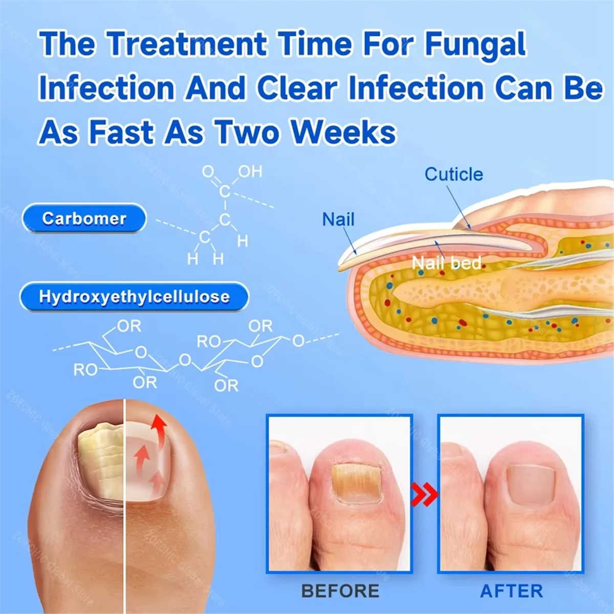 ABUYNail Fungus Laser Treatment Device Fingernail Fungus Treat Onychomycosis Effectively Remove Onychomycosis Grow Toe Nail