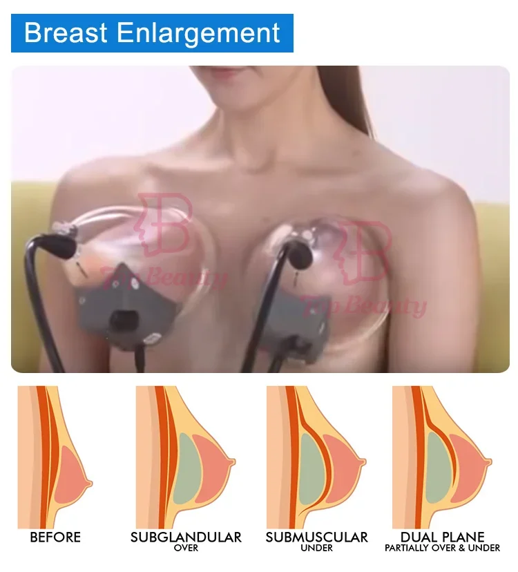 آلة رفع المؤخرة العلاجية Sp2 الاحترافية لتعزيز الثدي