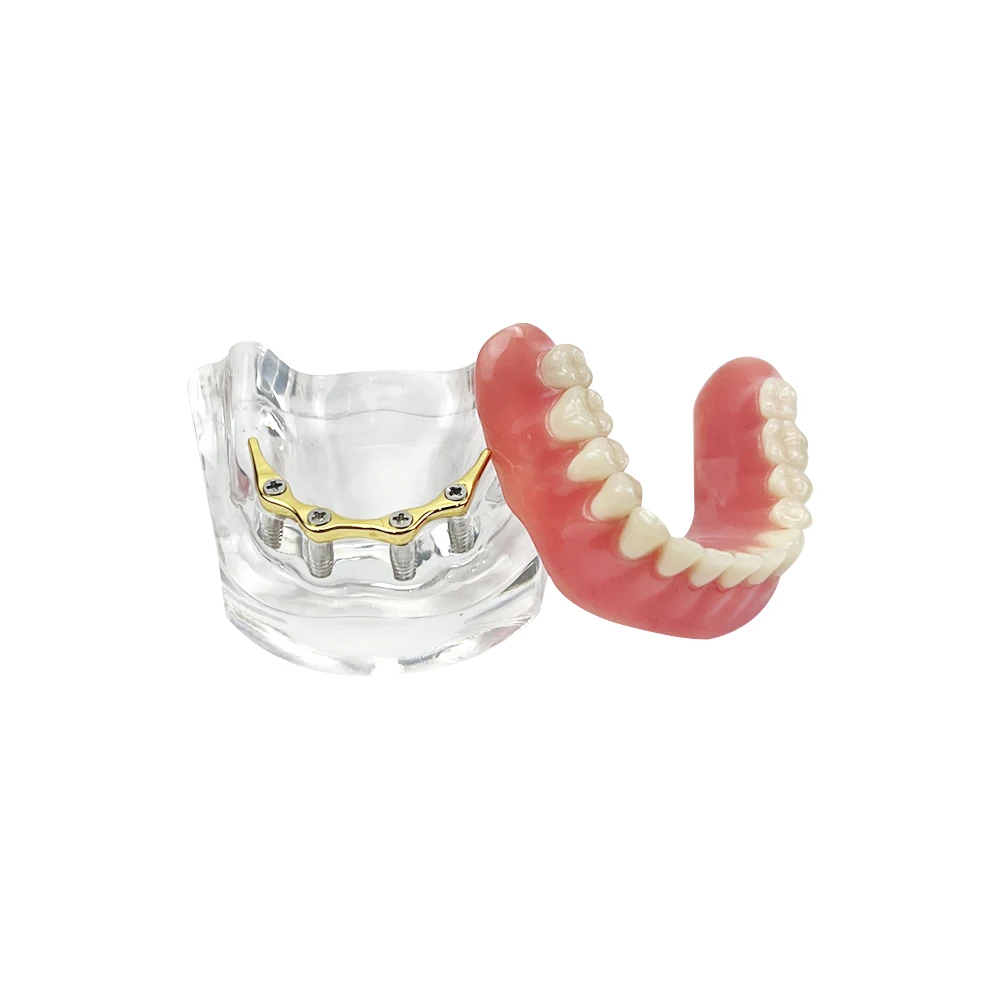 Implant żuchwy Model nauczania zębów dentystycznych Implant Most odbudowy Zdejmowany submaxillary Model na protezę do nauki