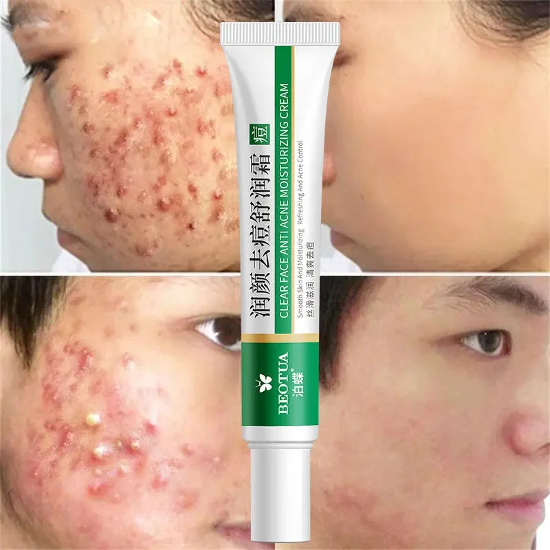 Effective Acne Removal Cream Herbal Acne Spots Oil Control Acne Scar Cream Removal Whitening Moisturizing Face Gel Skin Care 20g