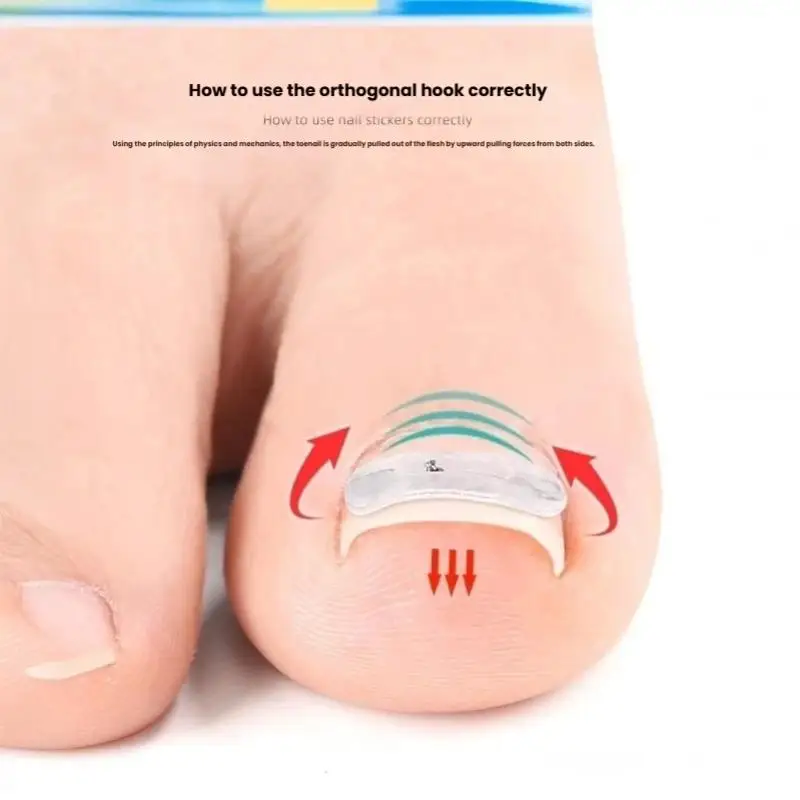 1 Set Ingrown Toenail Straightening Clip Brace Corrector Tool Stainless Steel Pedicure Recovery for Embedded Toe Nail Treatment