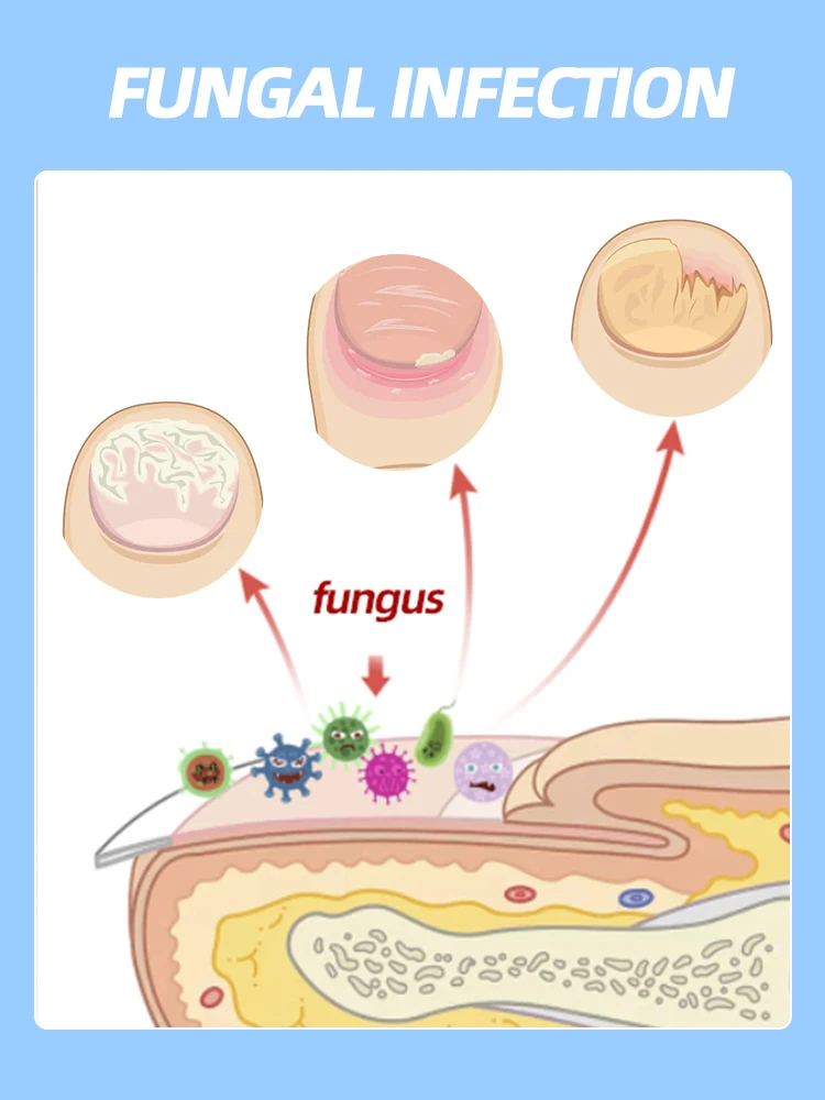 Óleo essencial para tratamento de fungos nas unhasrepara onicomicose em 7 dias
