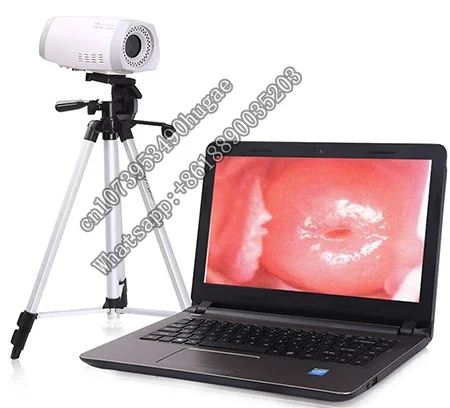 Digital  Device HD Video Vaginal   For Gynecology