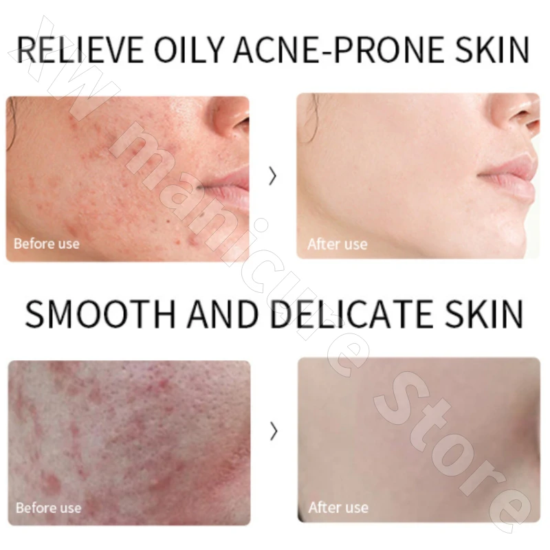 Facial Essence 30ml Repairs Damaged Skin Barrier, Improves Redness, Shrinks Large Pores and Is Suitable for Sensitive Skin