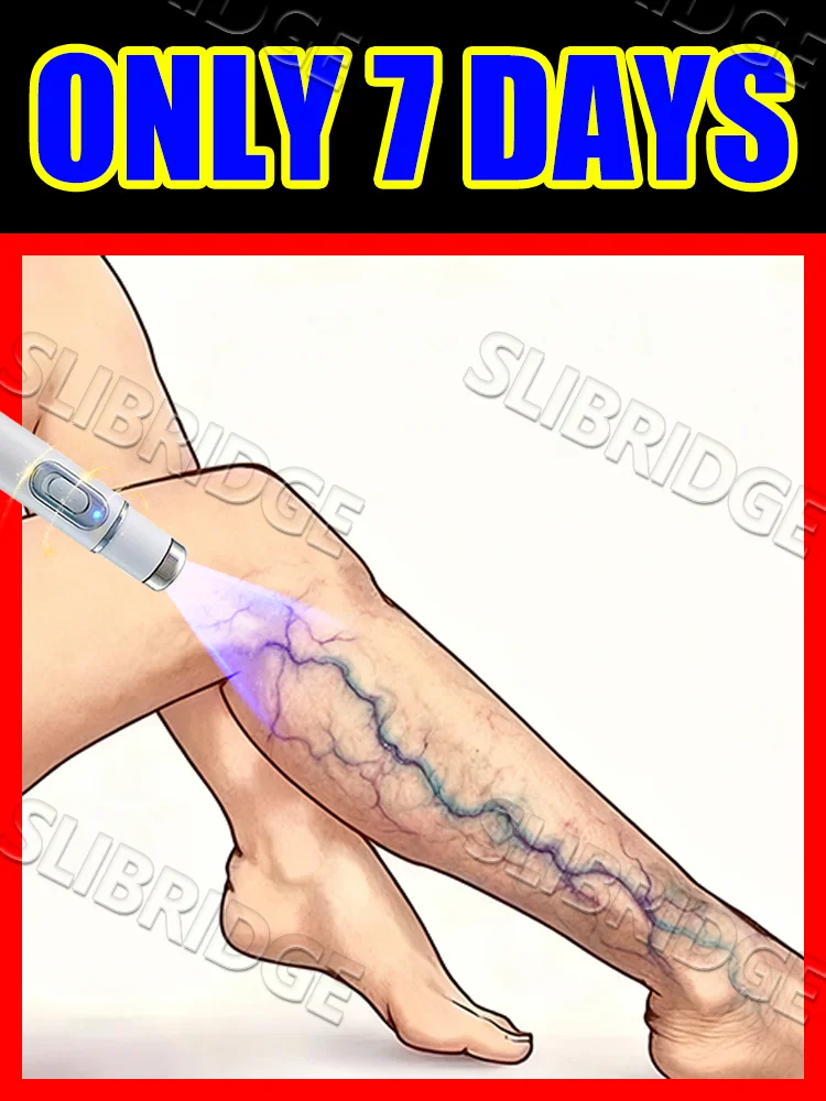

blue light pen solve veins,veins care tools,free shipping