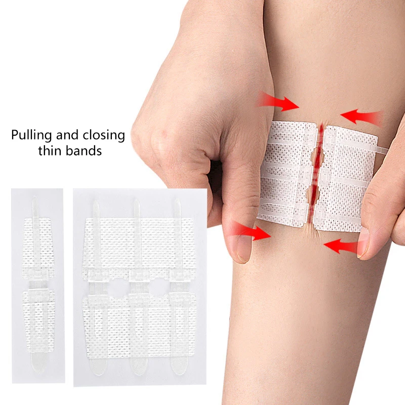 1Pc Rits Band Wond Sluiting Patch Rits Pleister Wond Snelle Hechting Buiten Draagbare Hemostatische Patch EHBO-Tool