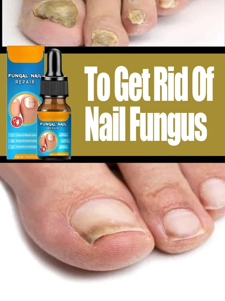 

Toenail Nail Fungus Treatment Repair Fingernail Device Toenail Treatment for Foot Nail Fungus Essential Oil Onychomycosis Care