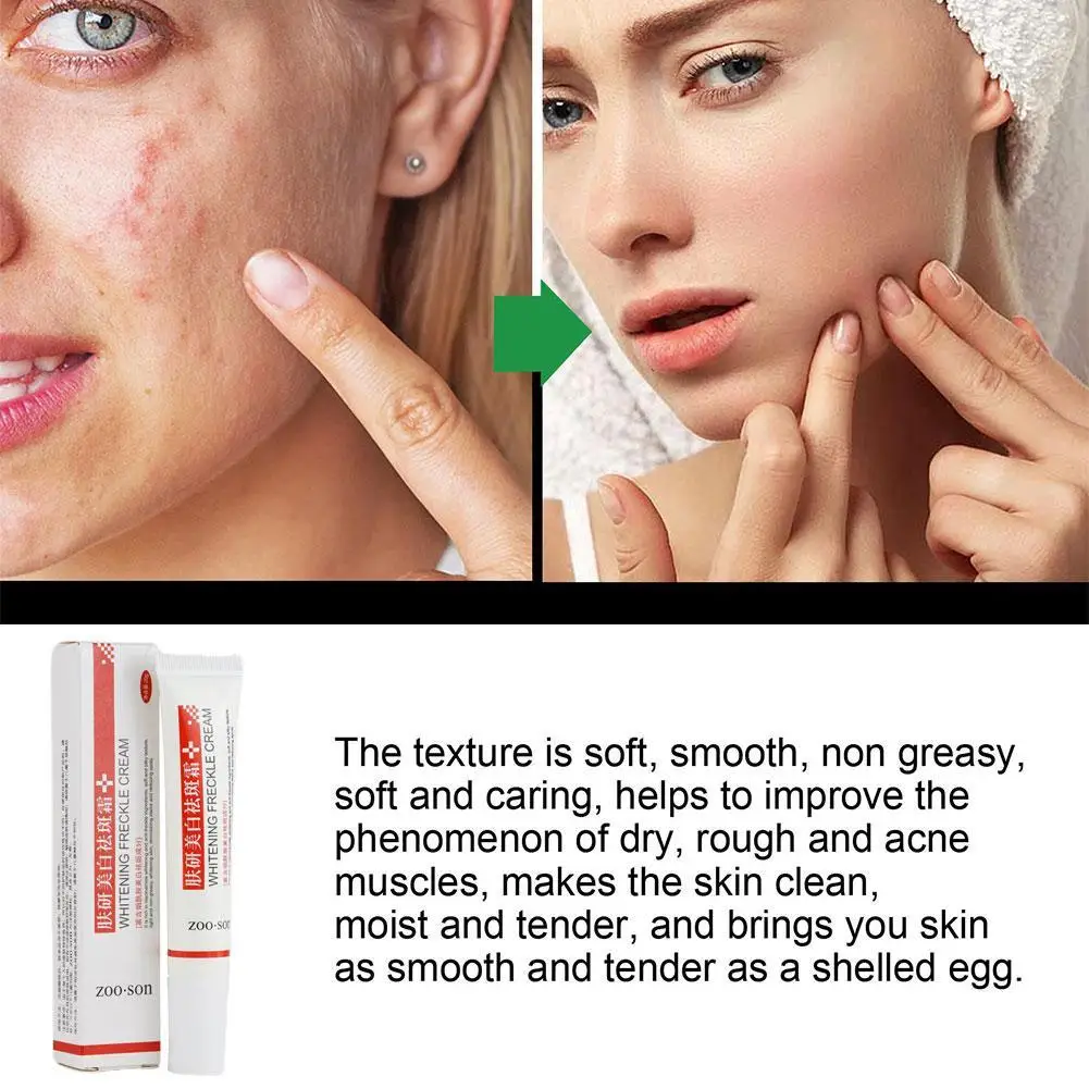 1/2/3pcs Whitening Freckle Cream Remove Dark Spots Anti Freckle Face Creams Niacinamide Fade Pigmentation Melasma Brighten Skin