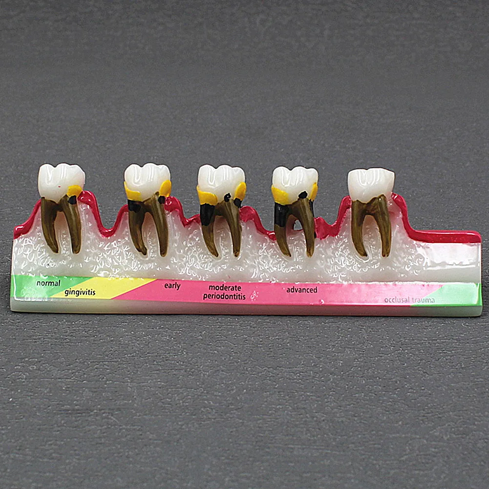 Dental Periodontal Disease Model Caries Fault Display Teaching Periodontal Model Dental Patient Communication