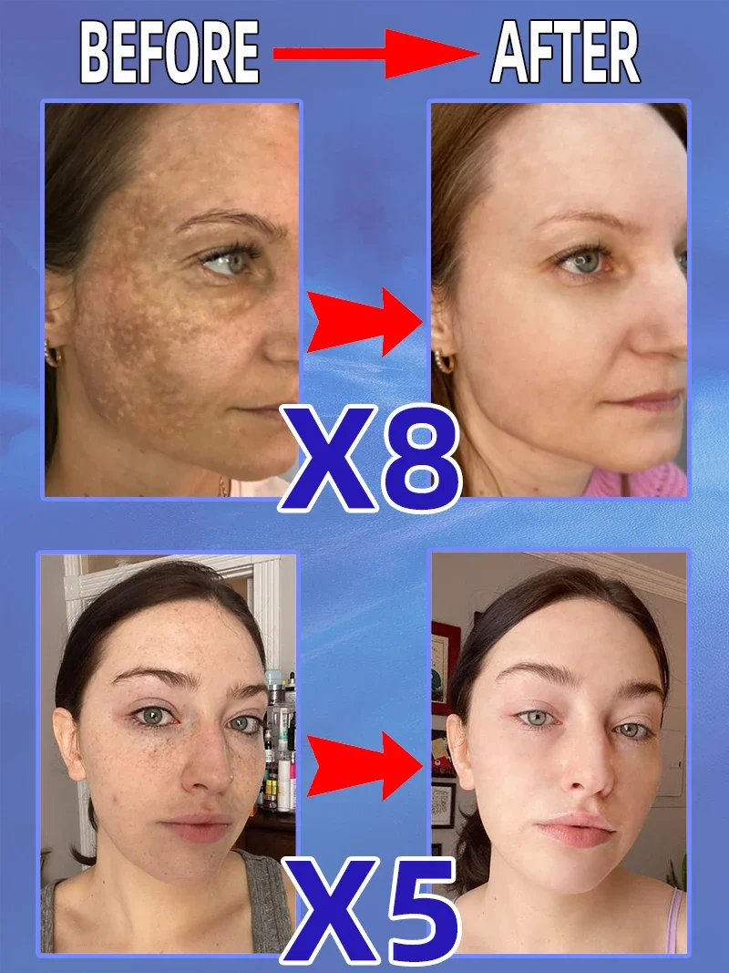 Freckles Melasma Chloasma Dark Spot