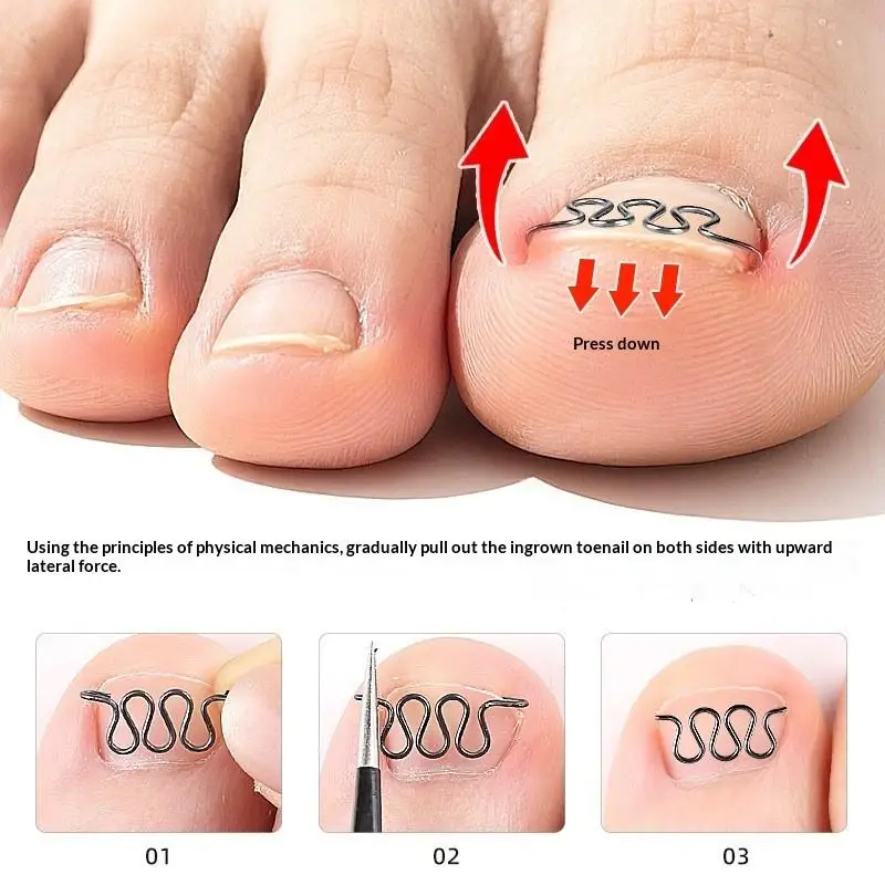 Ingrown Toenail Correction Wire Safe Toe Fix Tool Professional Curved Nail Corrector Stainless Steel Care Kit