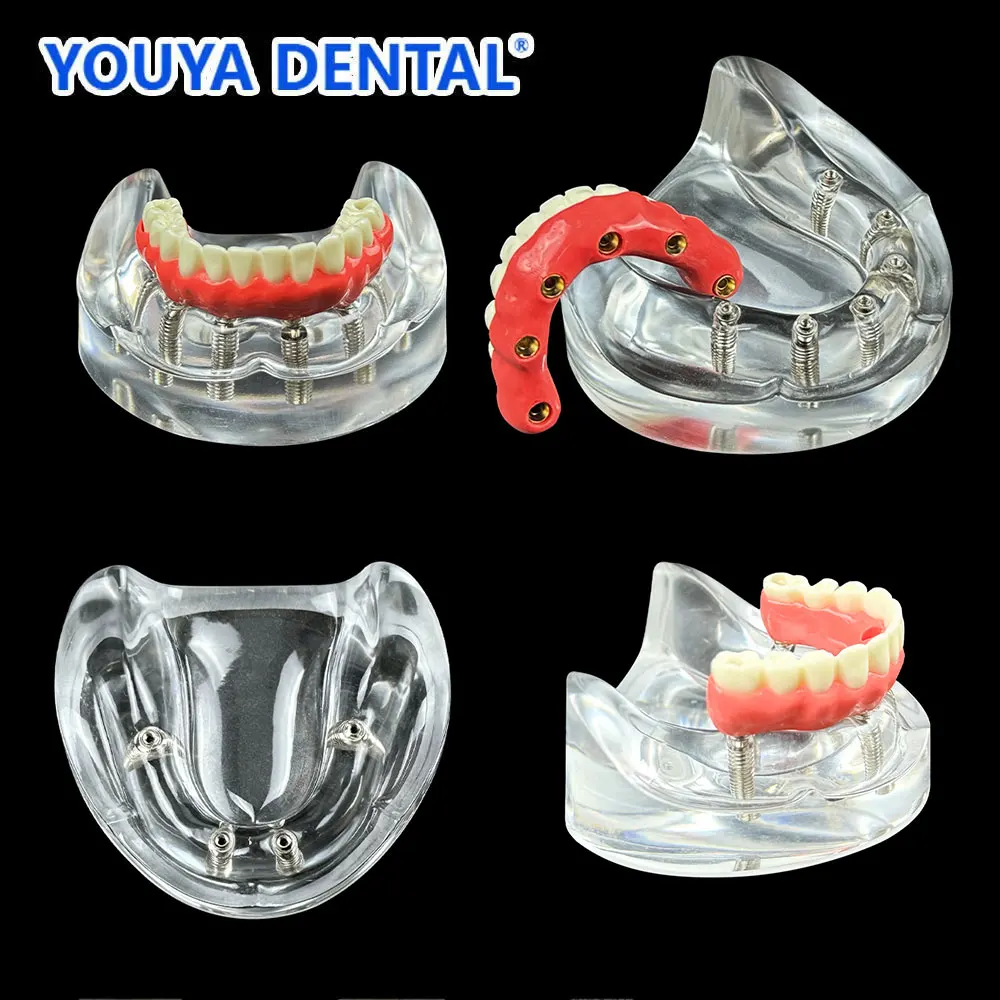 

Dental Typodont Teeth Study Implant Model Lower Jaw 4/6 Implants Overdenture Restoration for Researching Medical Dentist Study