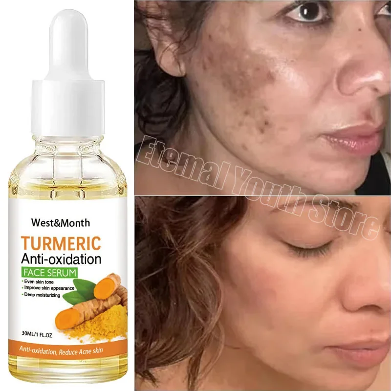 

Turmeric Dark Spot Remover Face Serum Whitening Freckle Melanin Correcting Essence Anti Pigmentation Brighten Skin Care Products