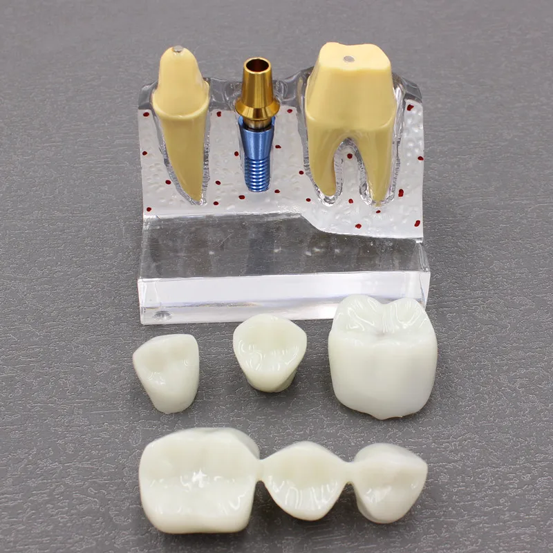 Dental Teeth Model With Implants Overdenture Superior Demo Model For Student Dentist patient communication model