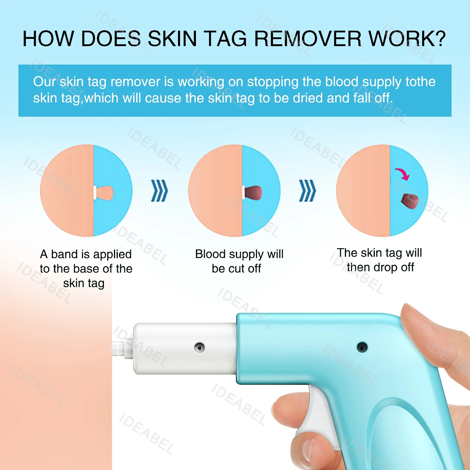 3-in-1 Auto Skin Tag Removal Kit Pijnloos Mol Wrattenverwijderaar Apparatuur Micro Skin Tag Treatment Tool Gemakkelijk schoon te maken Huidverzorgingstool