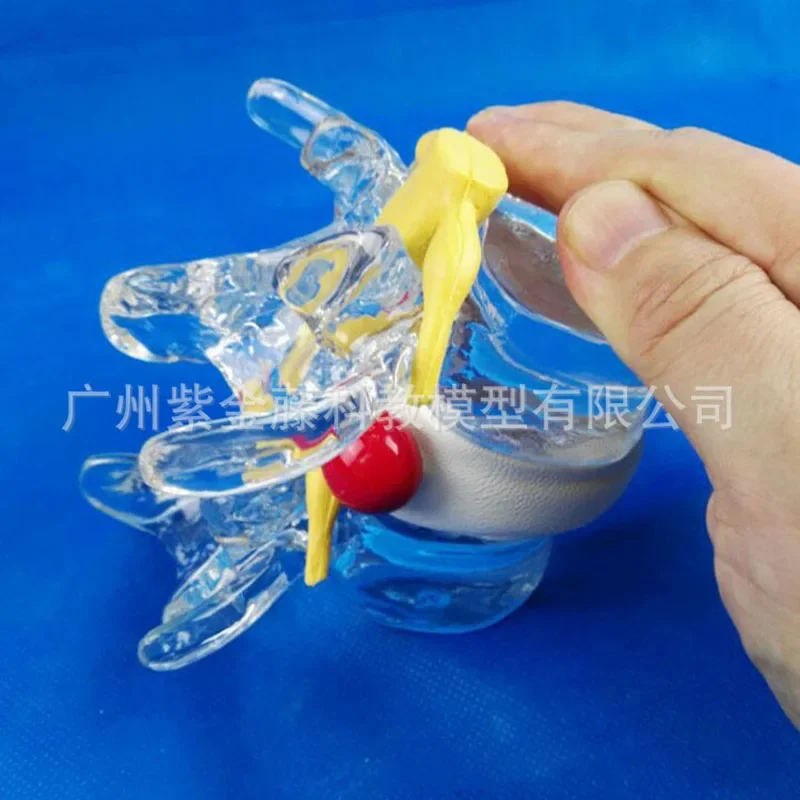 

Anatomical Human Lumbar Vertebrae Skeleton Anatomy Degenerative Lumbar Disc Herniation Demonstration Model Spine Medical Aids