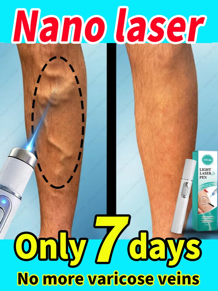 Blue Laser Heals Leg Veins