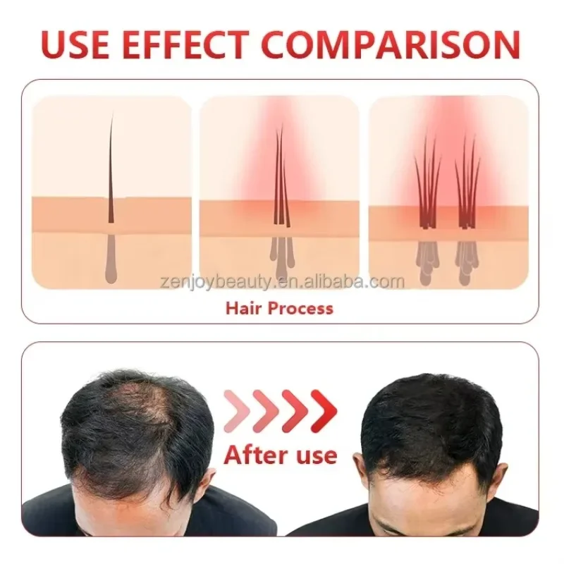 New in stock Infrared Red Light Therapy Cap 630nm 850nm 940nm Hair Regrowth and Headache Relief Hat Targets Head Area U