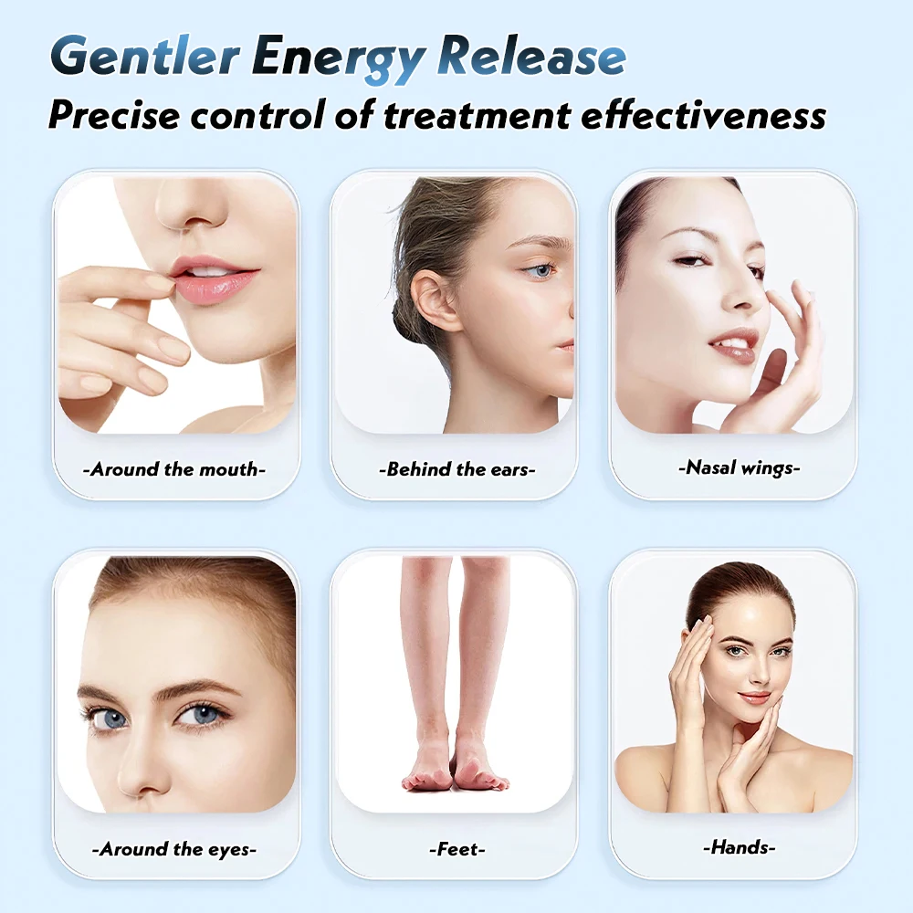 UVB-Lampe für Vitiligo-Phototherapie, Vitiligo-Behandlung, UV-Lampe, Laser-Psoriasis-Lampe, Phototherapie, Vitiligo mit Schutzbrille