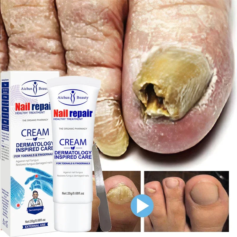 

Effective Nail Fungus Treatment Cream Foot Toe Nail Fungus Removal Serum Anti-infection Paronychia Onychomycosis Repair Gel Care