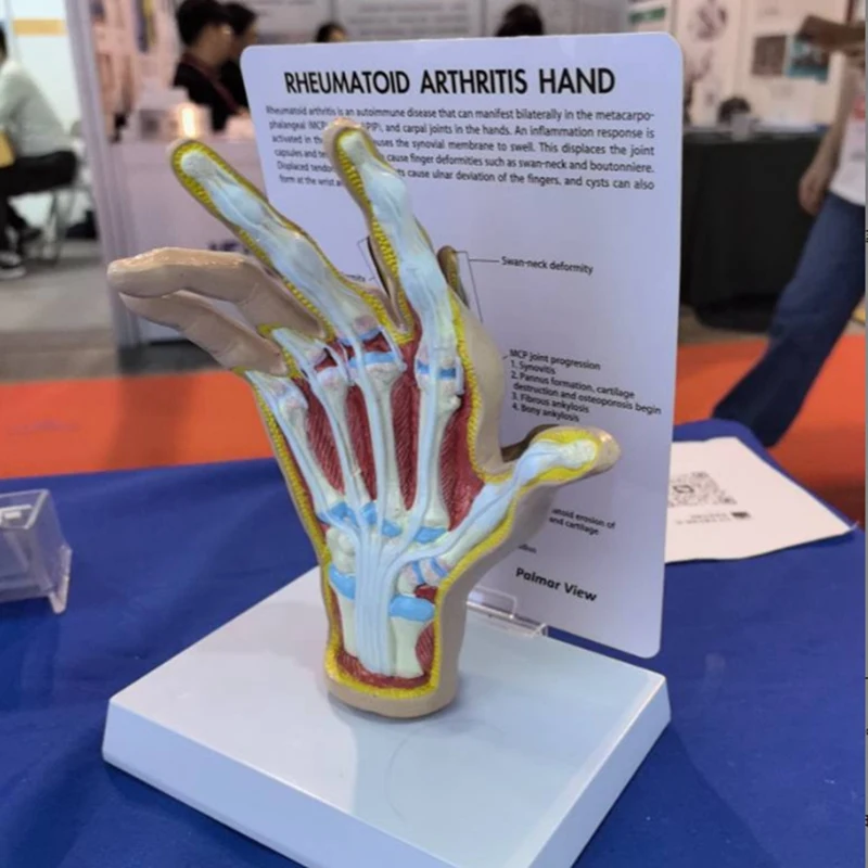 Osteoarthritis Hand Model, Model Of Hand Pathology, Human Anatomy And Physiology Replica, 's Office Anatomy Model