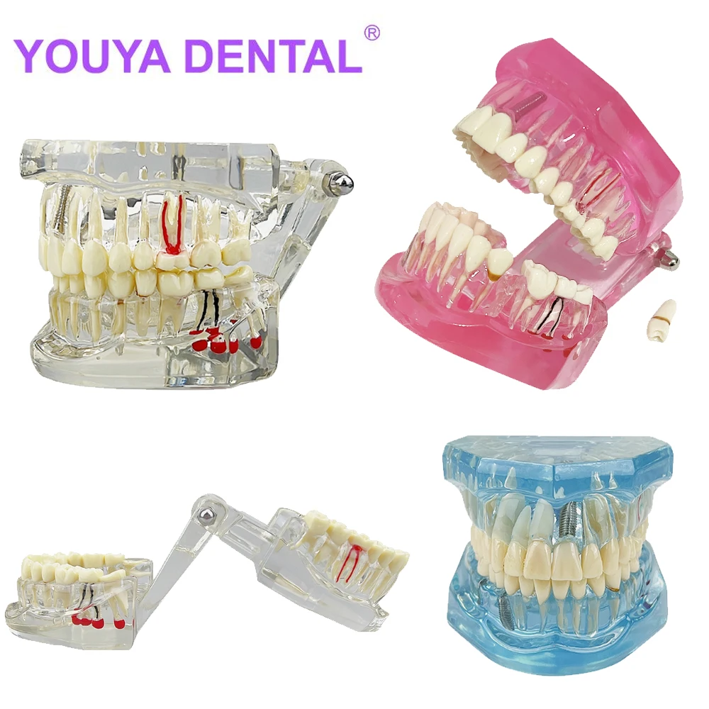 Dental Model Teeth Implant Restoration Bridge Teaching Study Medical Science Disease Analysis Model Dentist Dentistry Materials