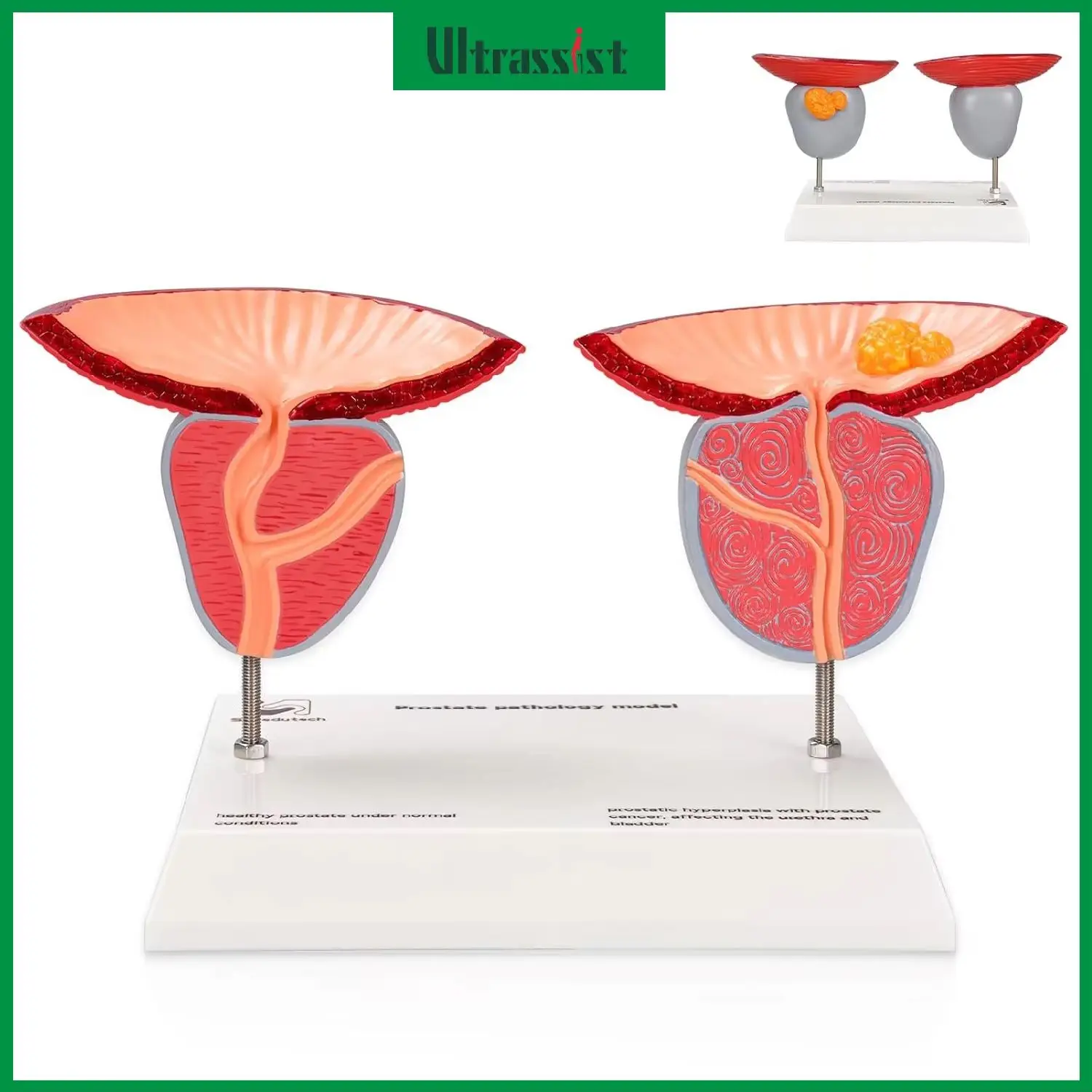 Ultrassist Prostate Pathological Anatomy Model Male Urinary Reproductive Detachable 3D Prostate BPH & Cancer for Medical Student