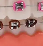 

1Pcs Dental Standard Tooth Model with Orthodontic Bracket Wire Buccal Tube Dentisit Studying Teaching Demonstration Tool