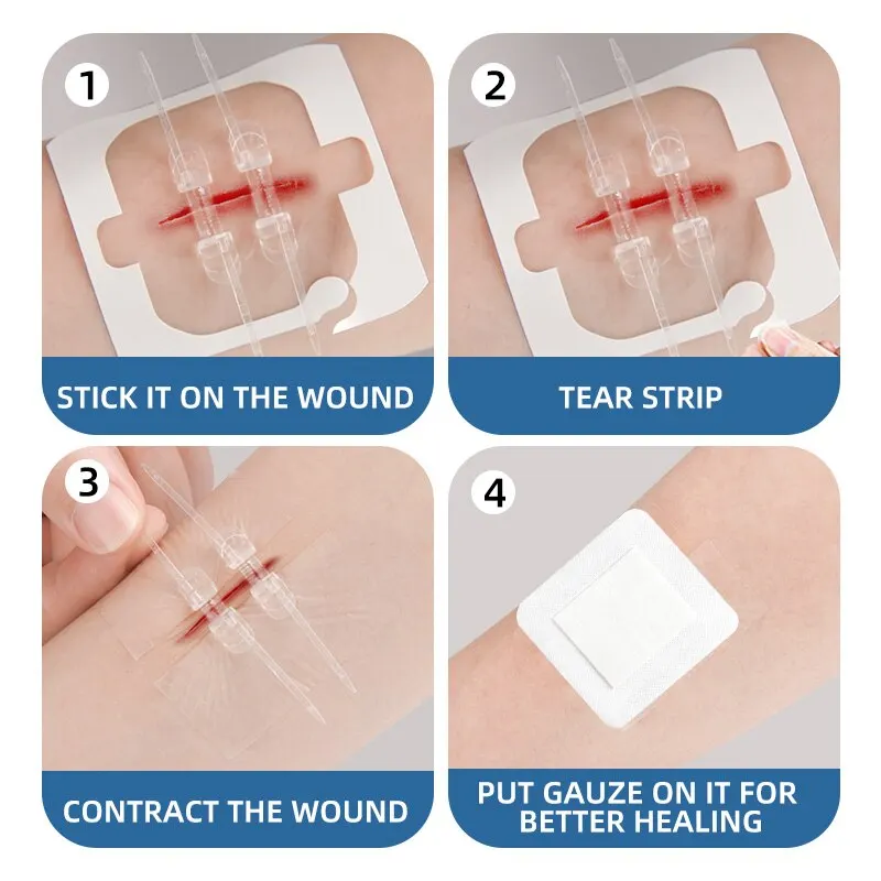 2pcs Zipper Tie Wound Closure Patch Hemostatic Patch Wound Fast Suture Zipper Band-Aid Outdoor Portable