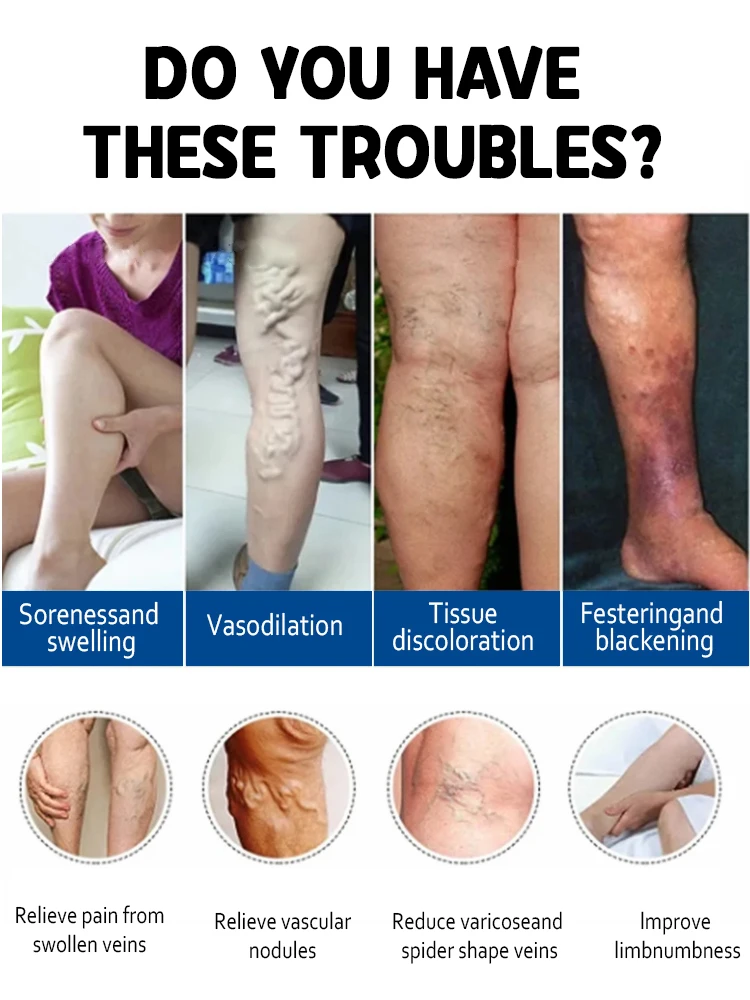Eliminate vasculitis, phlebitis, relieve spider leg pain, varicose veins painless treatment view 4