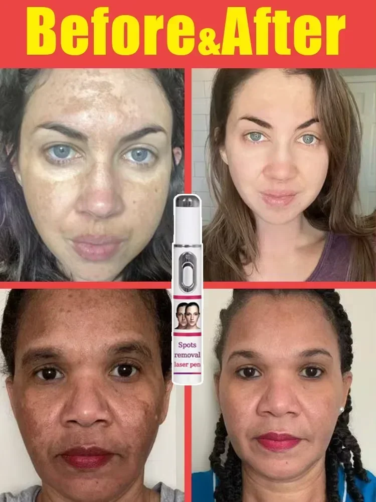 Freckles Melasma Melasma Dark Spots on Face Laser Pointer