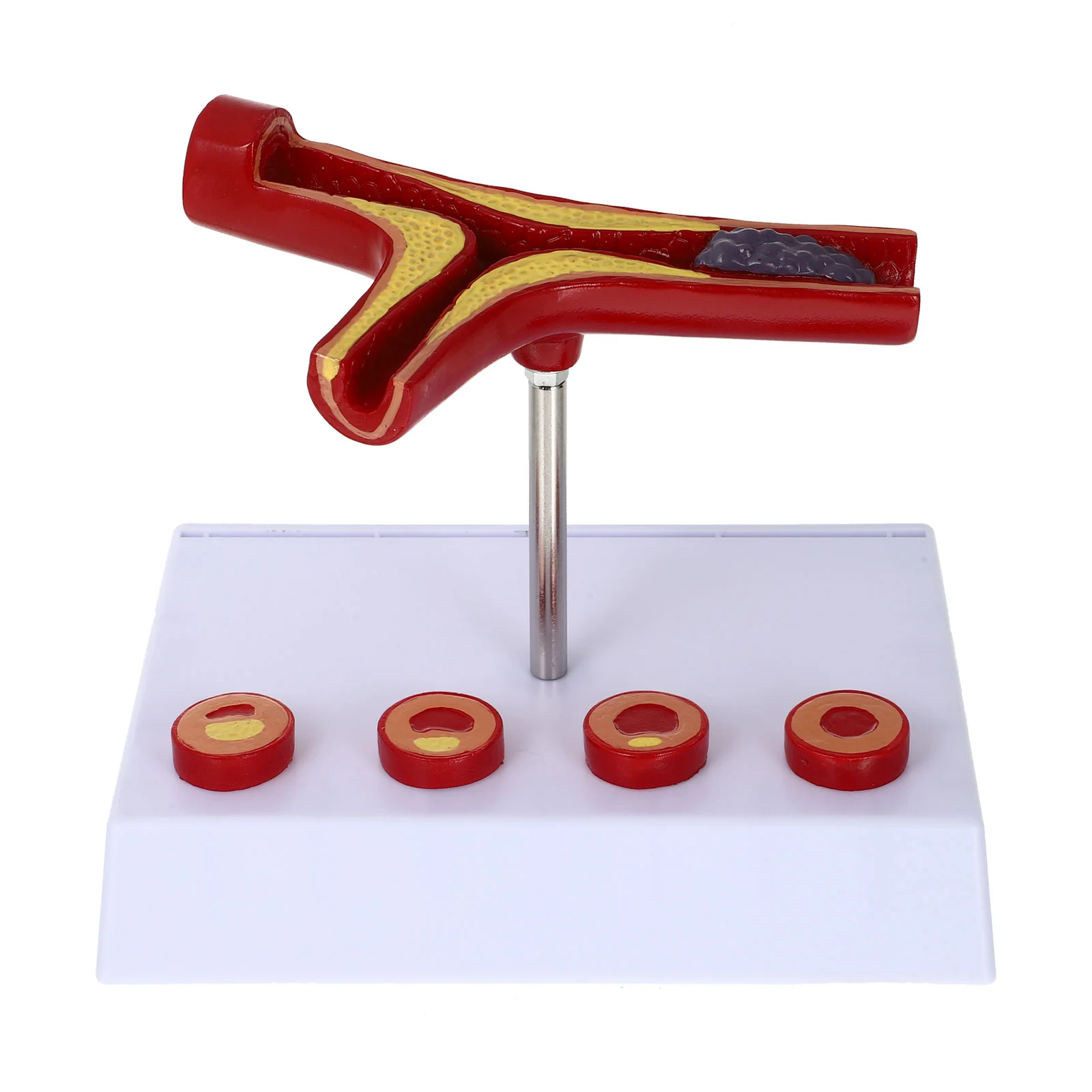 

Vascular Model Human Vessel Maniquin Atherosclerosis Medical Display Blood Hospital