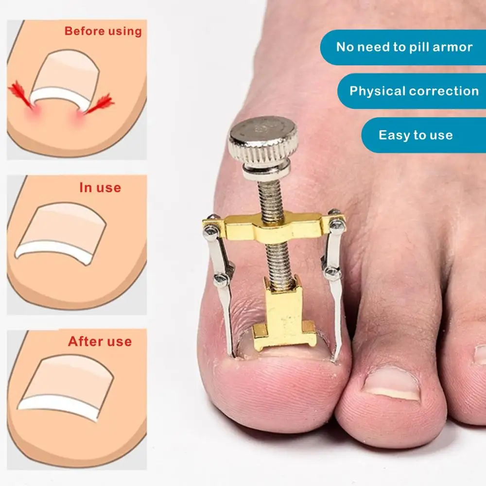 1Pcs Ingegroeide Teennagels Fixer Orthesen Toe Nail Herstellen Orthesen Correctie Tool Voetverzorging Apparaat Manicure Pedicure Set Machine