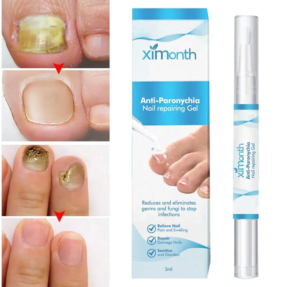 Caneta indolor do reparo do prego, Serum do reparo das unhas dos pés, Anti cuidado para mais grosso quebrado, Unhas descoloridas, L5m1